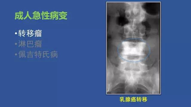 【PPT】识骨寻踪系列三——病变密度提示那些诊断线索