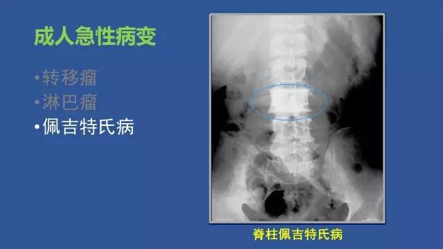 【PPT】识骨寻踪系列三——病变密度提示那些诊断线索