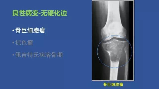 【PPT】识骨寻踪系列三——病变密度提示那些诊断线索
