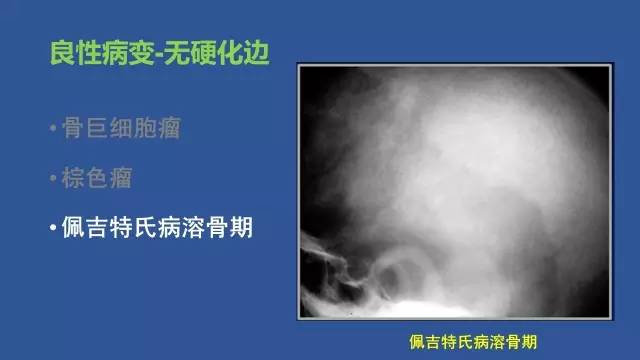 【PPT】识骨寻踪系列三——病变密度提示那些诊断线索