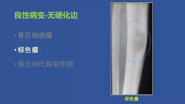 【PPT】识骨寻踪系列三——病变密度提示那些诊断线索