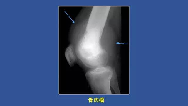 【PPT】识骨寻踪系列三——病变密度提示那些诊断线索