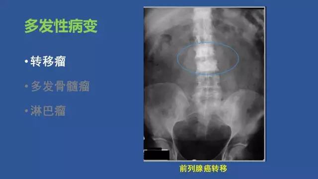 【PPT】识骨寻踪系列三——病变密度提示那些诊断线索