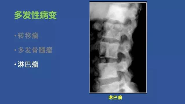 【PPT】识骨寻踪系列三——病变密度提示那些诊断线索