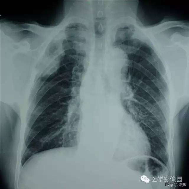 【病例】肋骨海绵状血管瘤1例CT影像表现