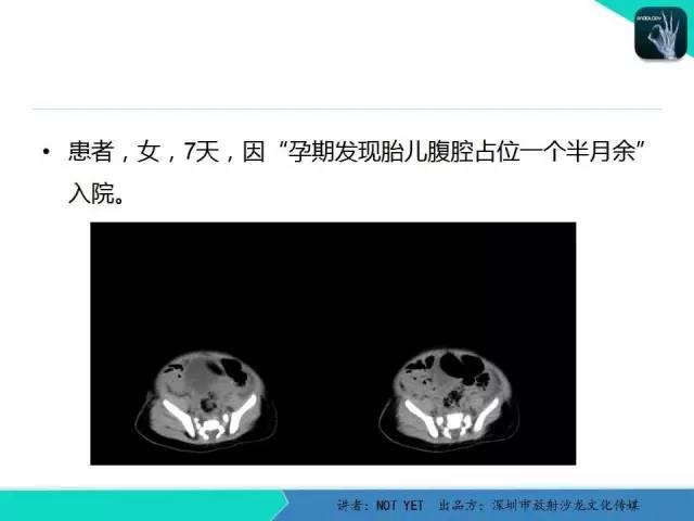【病例】新生儿卵巢病理性囊肿1例CT影像表现
