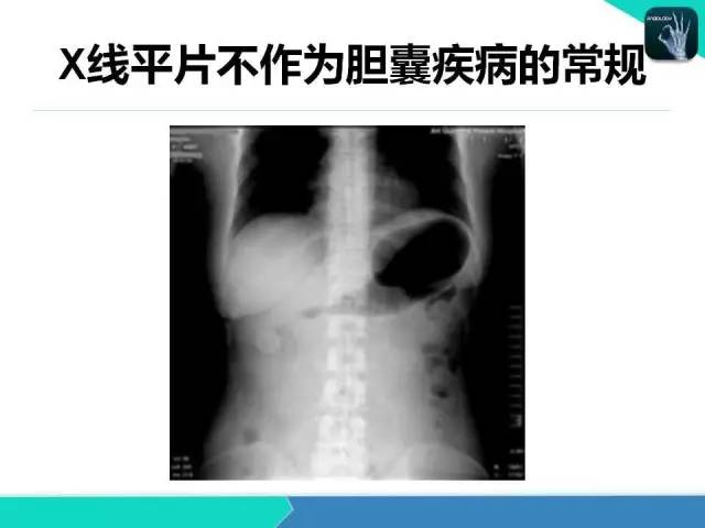 【PPT】胆道系统影像诊断