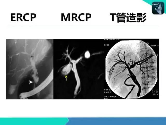 【PPT】胆道系统影像诊断