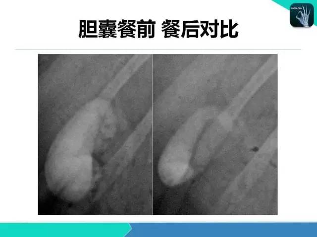 【PPT】胆道系统影像诊断