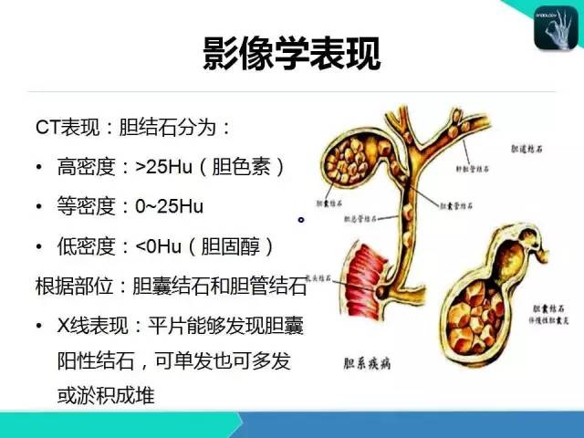 【PPT】胆道系统影像诊断