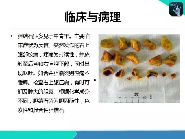 【PPT】胆道系统影像诊断