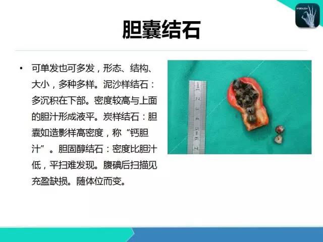 【PPT】胆道系统影像诊断