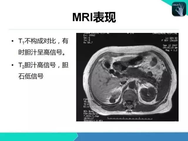 【PPT】胆道系统影像诊断