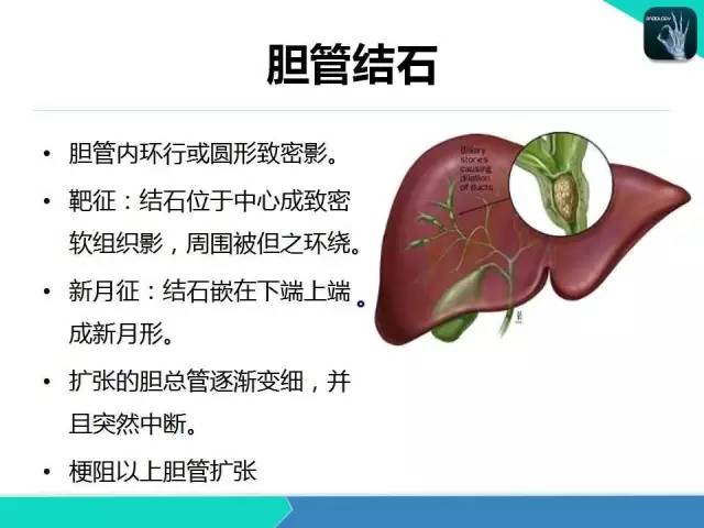 【PPT】胆道系统影像诊断
