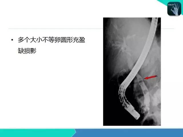 【PPT】胆道系统影像诊断