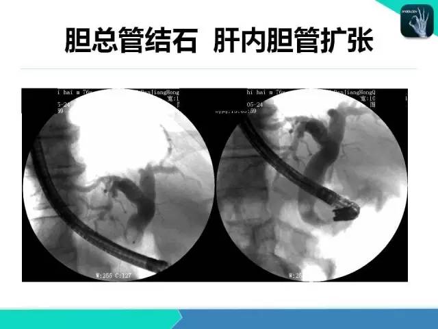 【PPT】胆道系统影像诊断