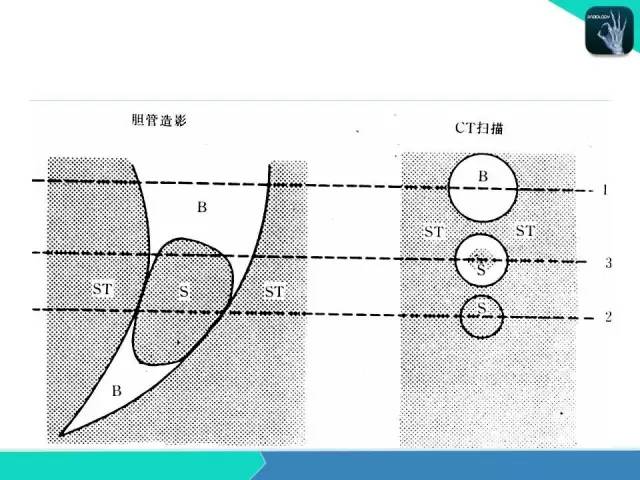 【PPT】胆道系统影像诊断