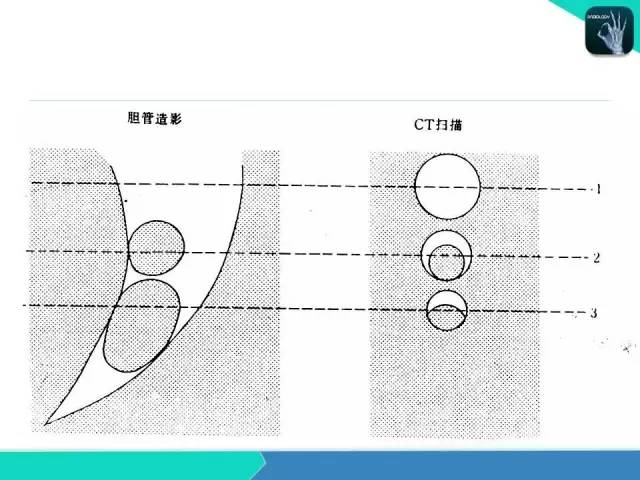 【PPT】胆道系统影像诊断