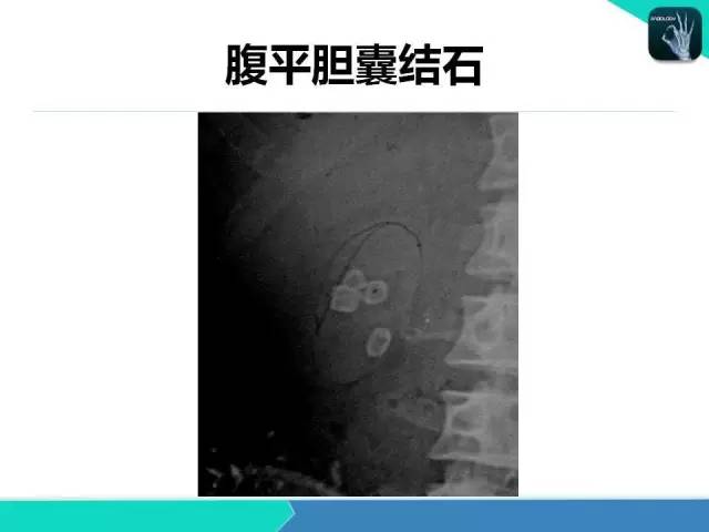 【PPT】胆道系统影像诊断