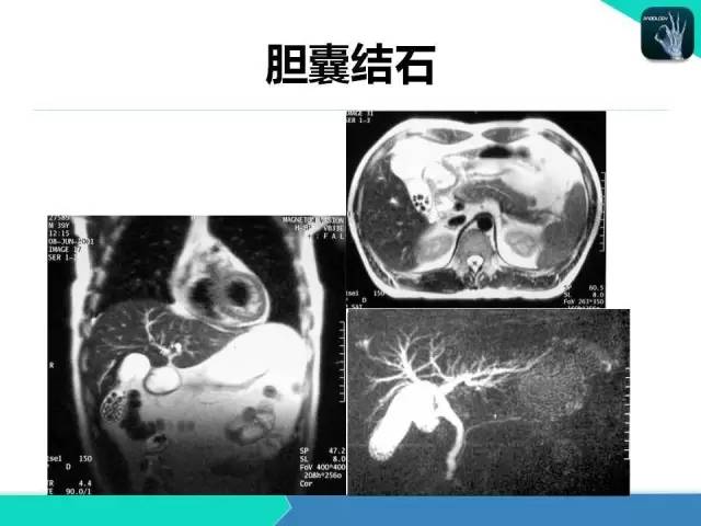 【PPT】胆道系统影像诊断