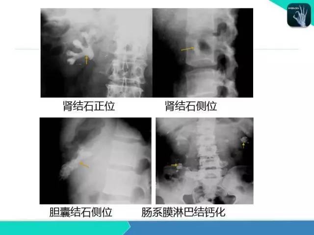 【PPT】胆道系统影像诊断