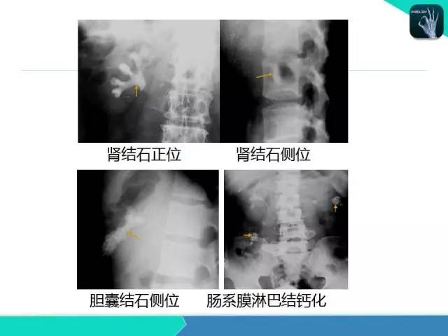 【PPT】胆道系统影像诊断