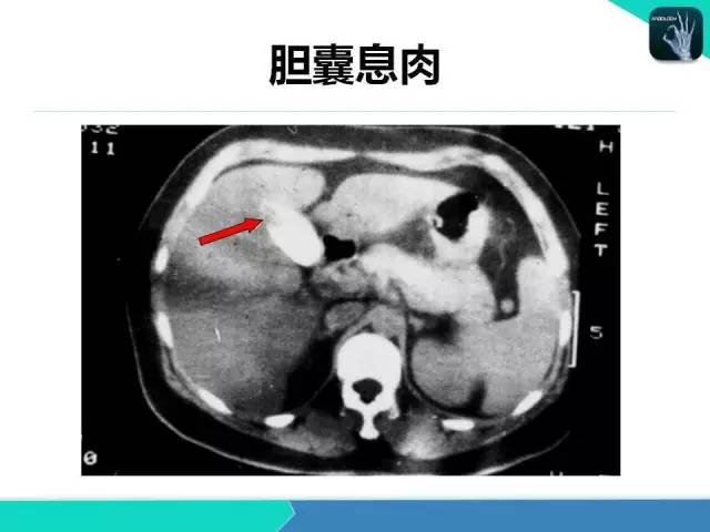 【PPT】胆道系统影像诊断