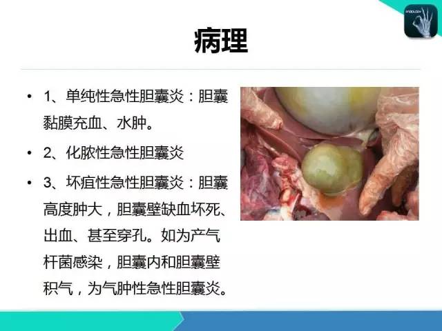 【PPT】胆道系统影像诊断