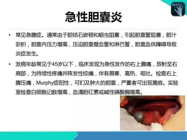 【PPT】胆道系统影像诊断