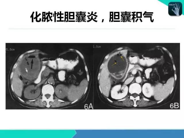 【PPT】胆道系统影像诊断