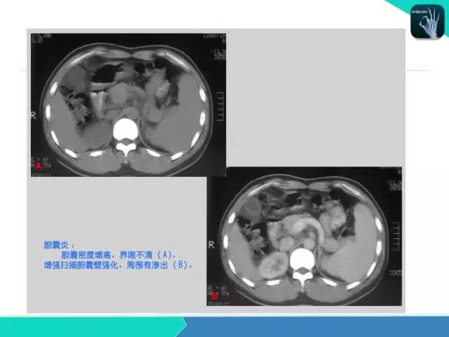 【PPT】胆道系统影像诊断