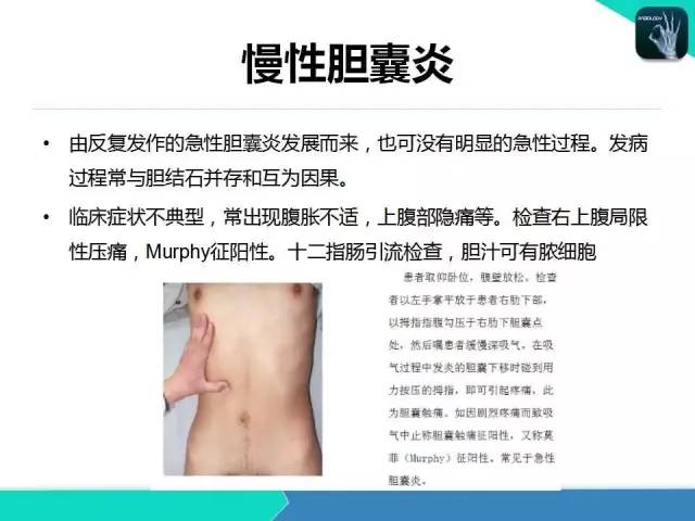 【PPT】胆道系统影像诊断