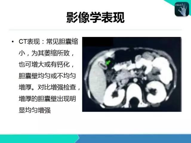 【PPT】胆道系统影像诊断