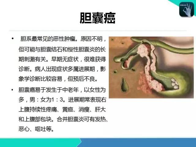 【PPT】胆道系统影像诊断