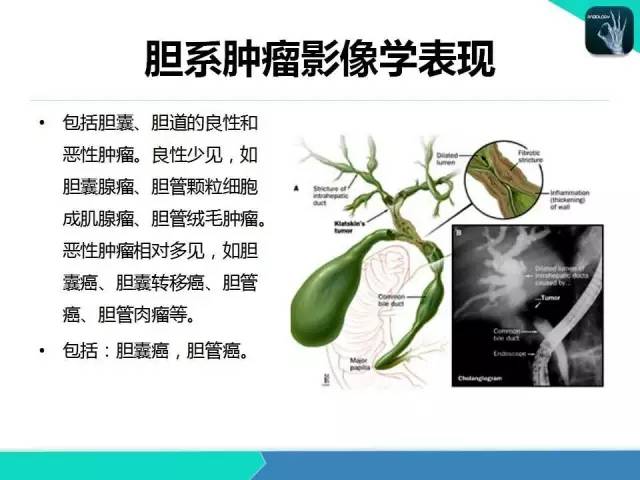 【PPT】胆道系统影像诊断