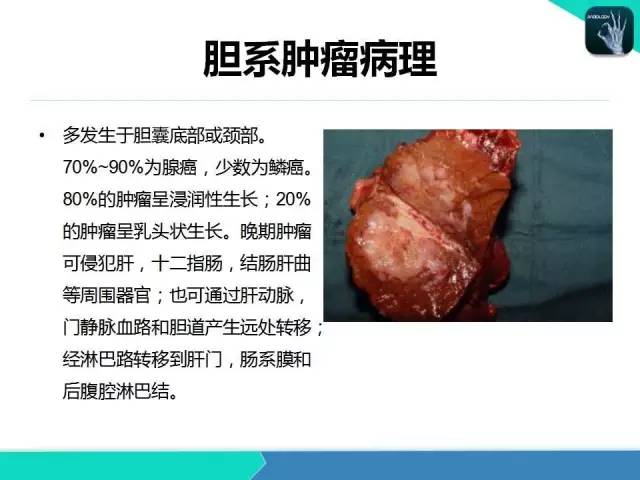 【PPT】胆道系统影像诊断