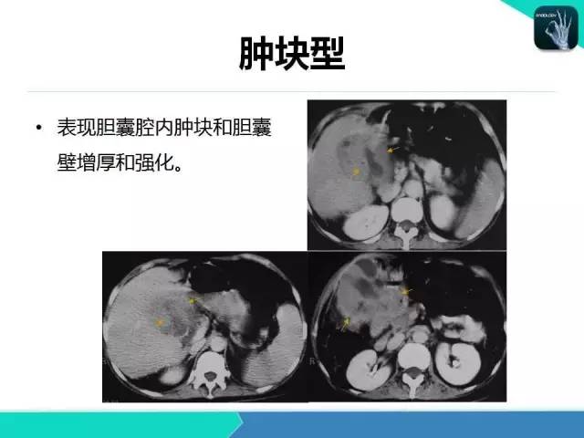 【PPT】胆道系统影像诊断