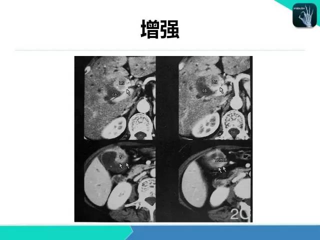 【PPT】胆道系统影像诊断