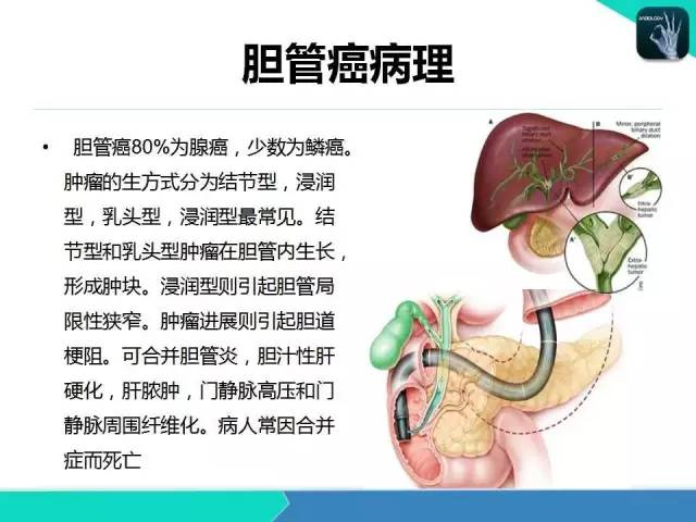 【PPT】胆道系统影像诊断