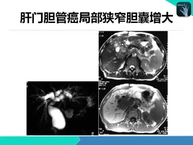 【PPT】胆道系统影像诊断
