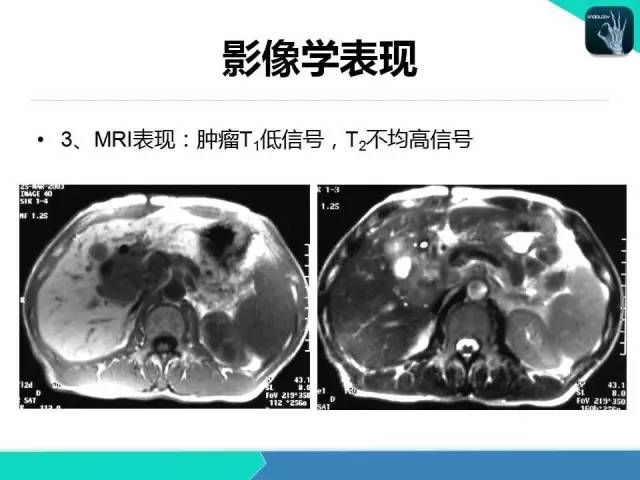 【PPT】胆道系统影像诊断