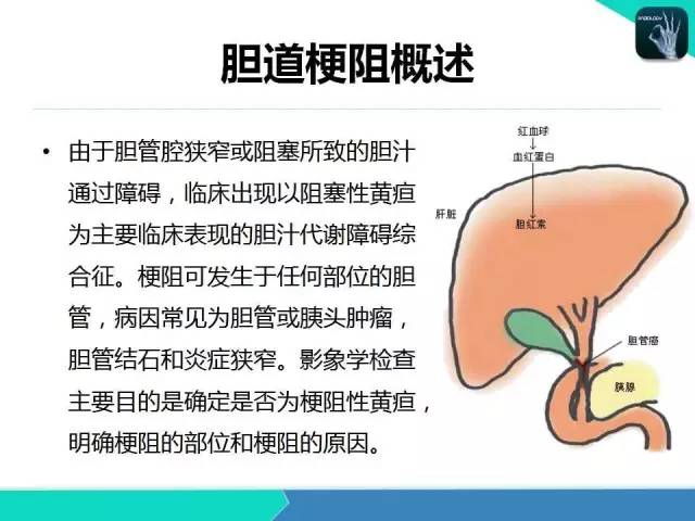 【PPT】胆道系统影像诊断