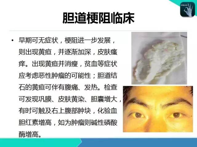 【PPT】胆道系统影像诊断