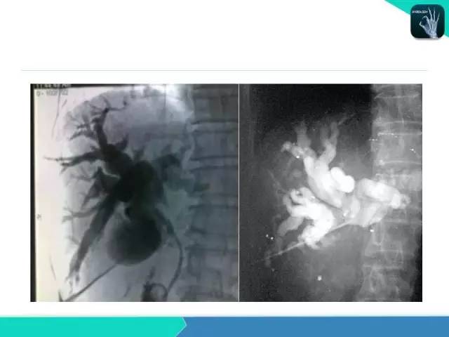 【PPT】胆道系统影像诊断