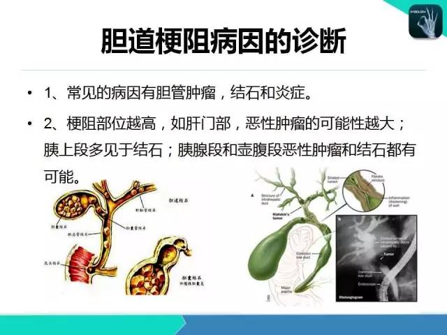 【PPT】胆道系统影像诊断