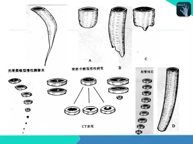 【PPT】胆道系统影像诊断