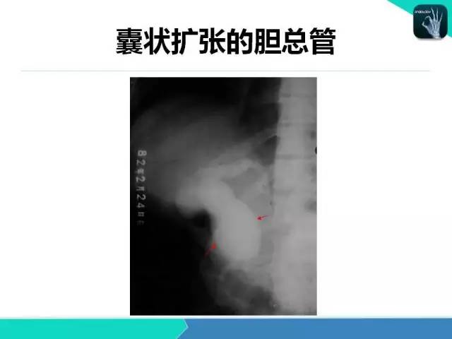 【PPT】胆道系统影像诊断
