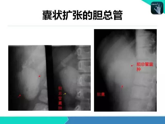 【PPT】胆道系统影像诊断