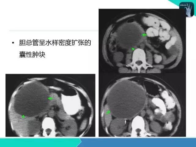 【PPT】胆道系统影像诊断