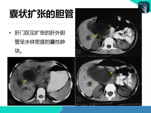 【PPT】胆道系统影像诊断